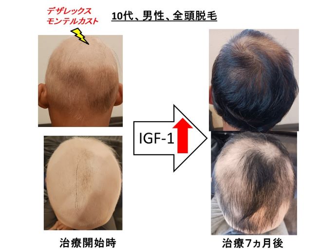 円形脱毛症　病院